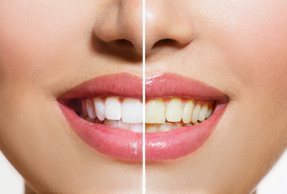 Stained Teeth | Hickman NE Dentist